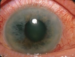 Acute_Angle_Closure-glaucoma