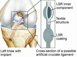 Reaserchers launch new medical technology project investigating a cmposite structure made of silicone rubber for use as a cruciate ligament implant