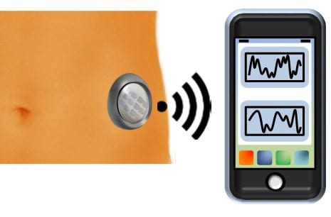 Tissue Implantable Insulin Sensors