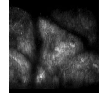 Measuring skin rejuvenation with two-photon microscopy