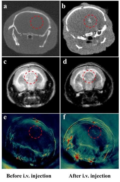 Analytical Trident in the Fight Against Glioma