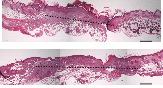 Porous silicon nanoparticles improve diabetic wound healing