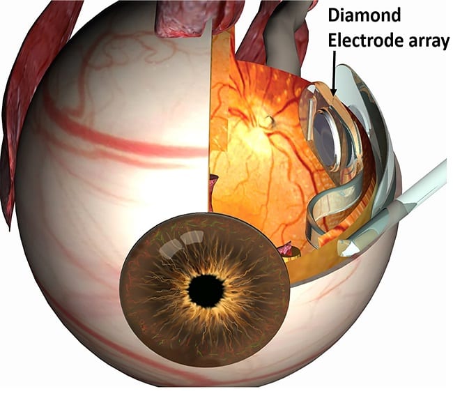 Diamonds for prosthetic vision