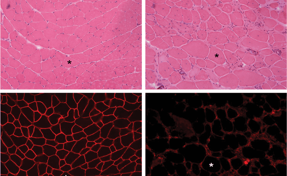 Nanotherapy Treatments Aim to Change Duchenne Muscular Dystrophy’s Outcome