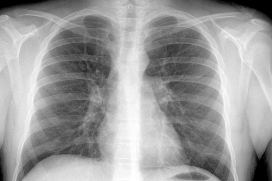 Image-based Computational Fluid Dynamics in the Lung: Virtual Reality or New Clinical Practice?