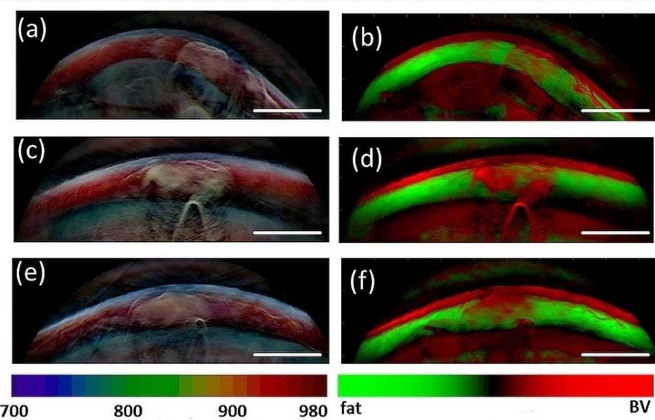 Optoacoustic Imaging To Complement Ultrasound Tumor Diagnosis