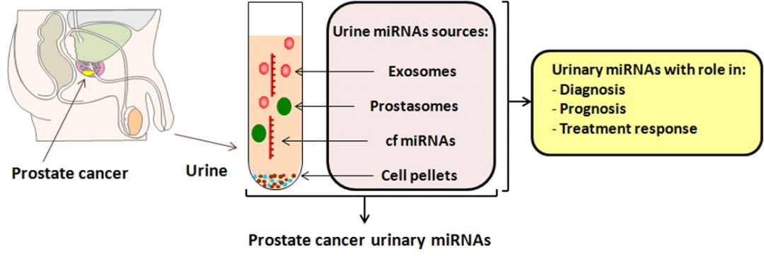Urinary microRNAs for Prostate Cancer Diagnosis, Prognosis, and Treatment Response – Are We There Yet?