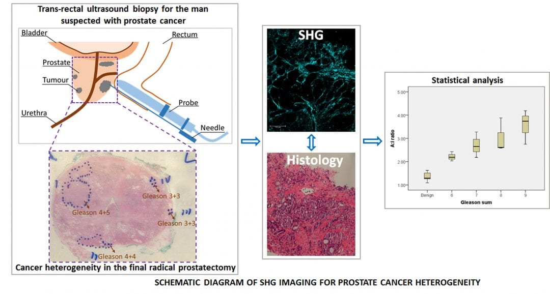 Improving Prostate Cancer Diagnosis Through Imaging Collagen