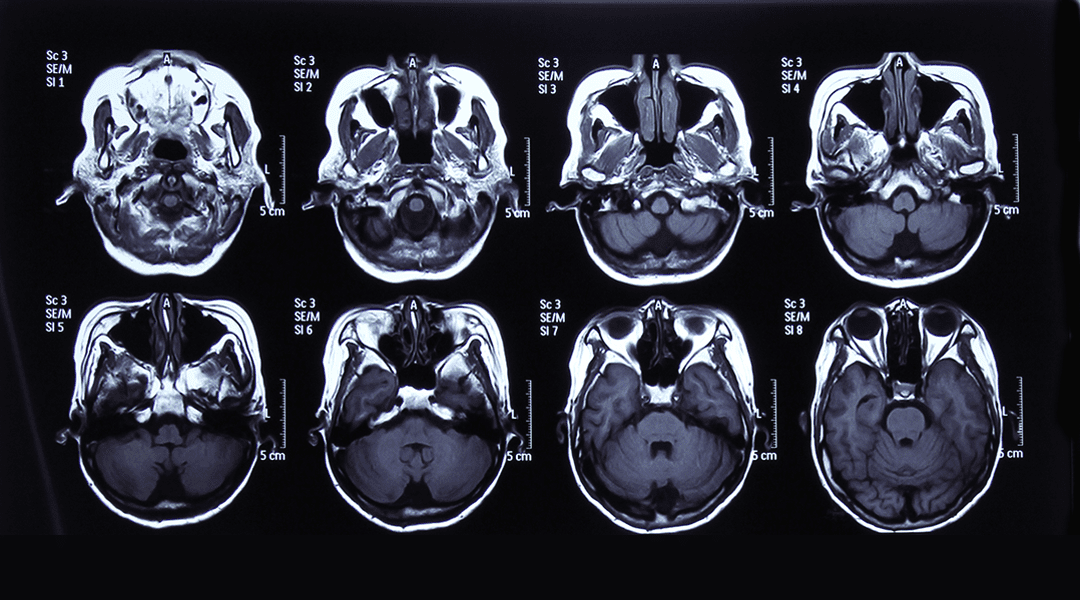 Developmental Origins and Oncogenic Pathways in Malignant Brain Tumors