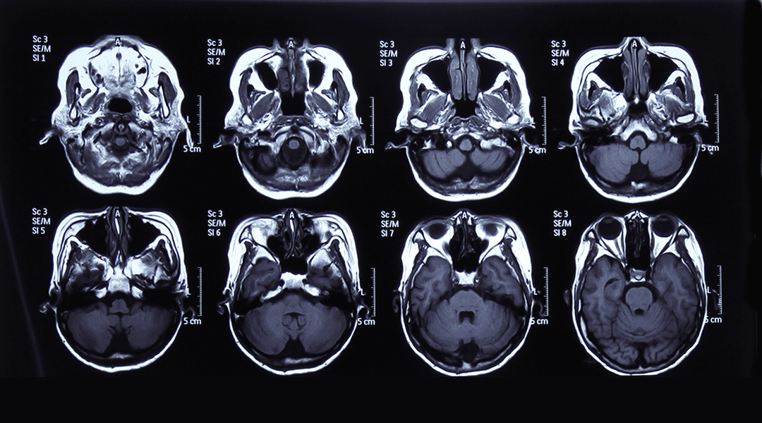 Tracking Transplanted Stem Cells by Dual-Contrast MRI