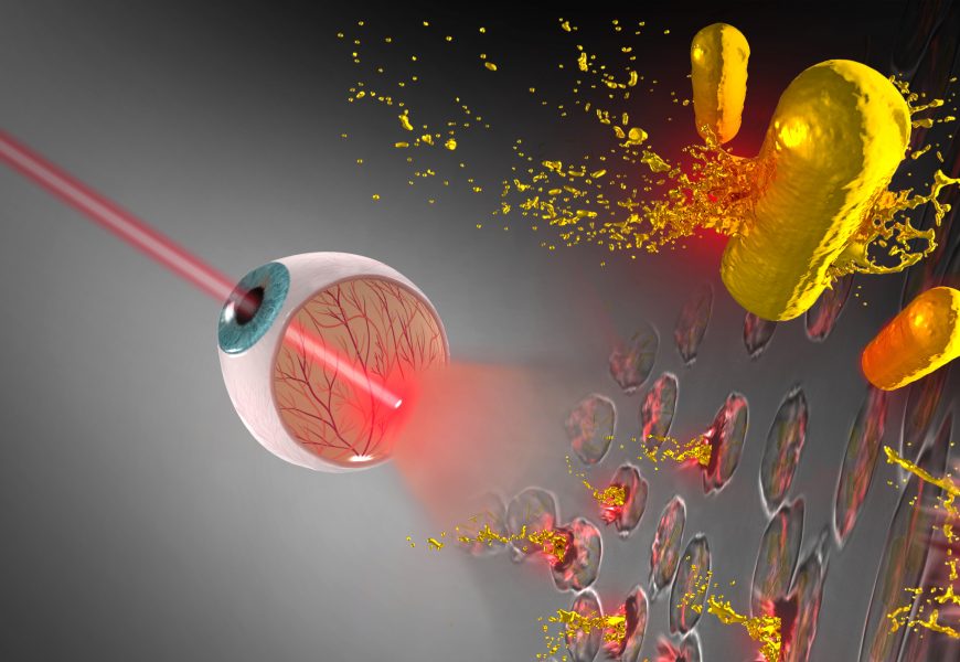 Lasering in on Retinoblastoma