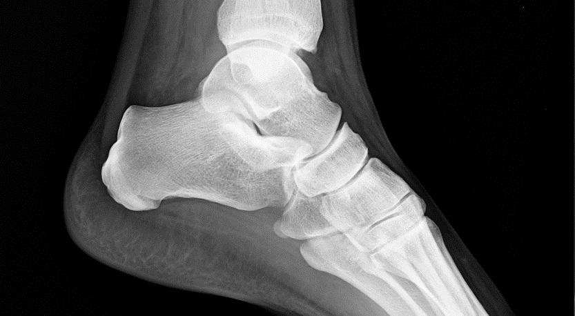 Using Raman Spectroscopy To Assess Brittle Bones