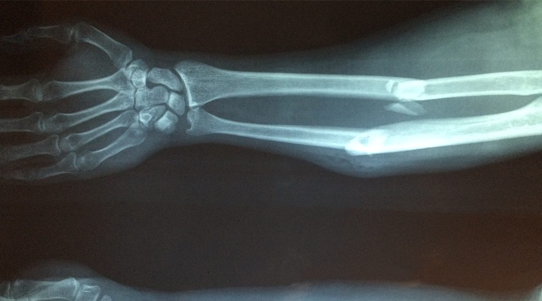 Getting Tough: Photopolymers to Enhance Bone Scaffold Materials