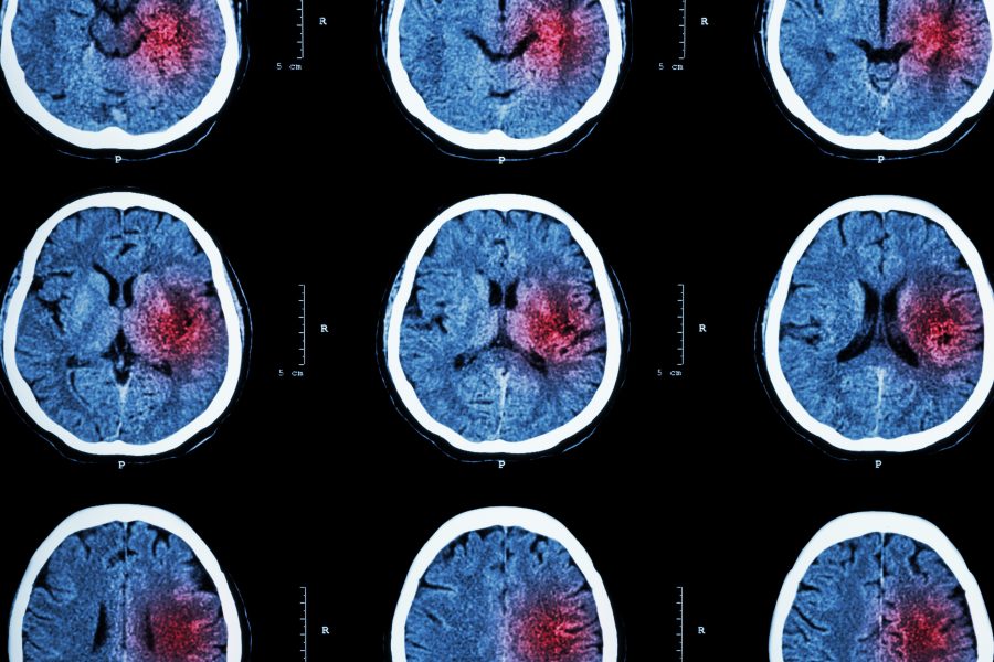 Can Stroke Mortality in Hospital Be Prevented?