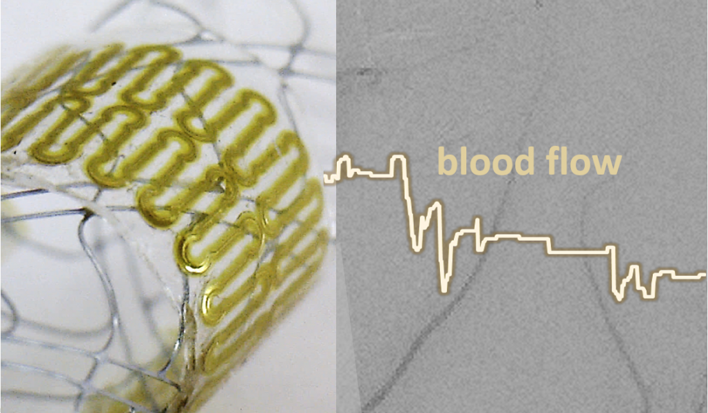 Implantable Electronics for Cerebral Aneurysm Monitoring