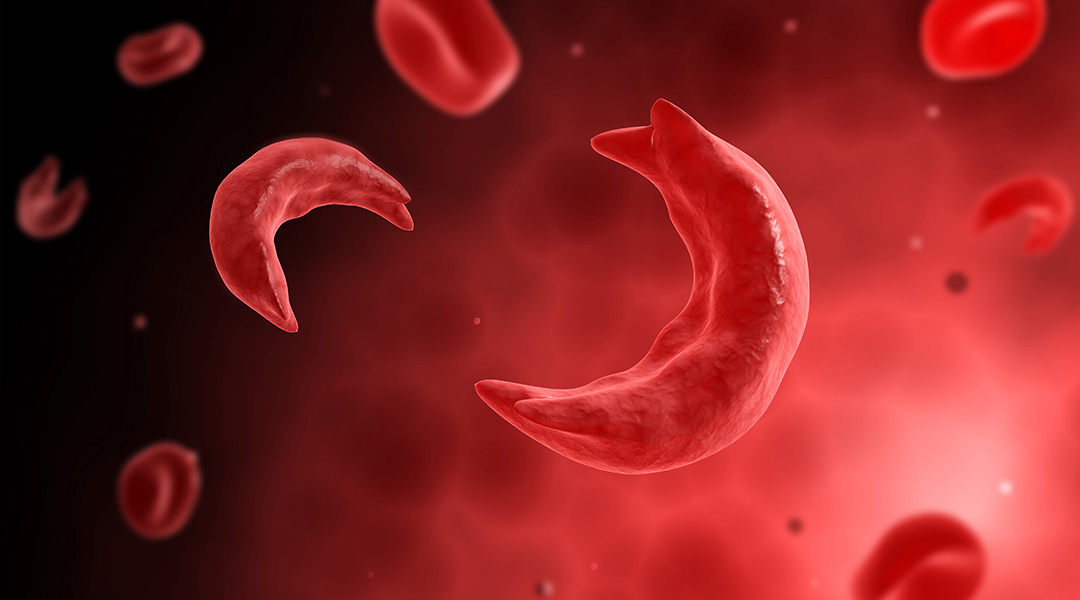 The first CRISPR gene therapy to cure sickle-cell disease