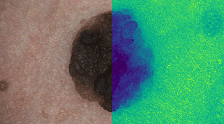 Detecting Skin Cancer Using Hyperspectral Images Advanced Science News