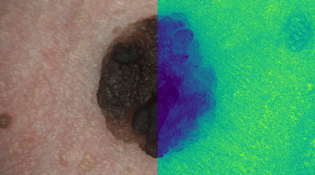 Detecting skin cancer using hyperspectral images