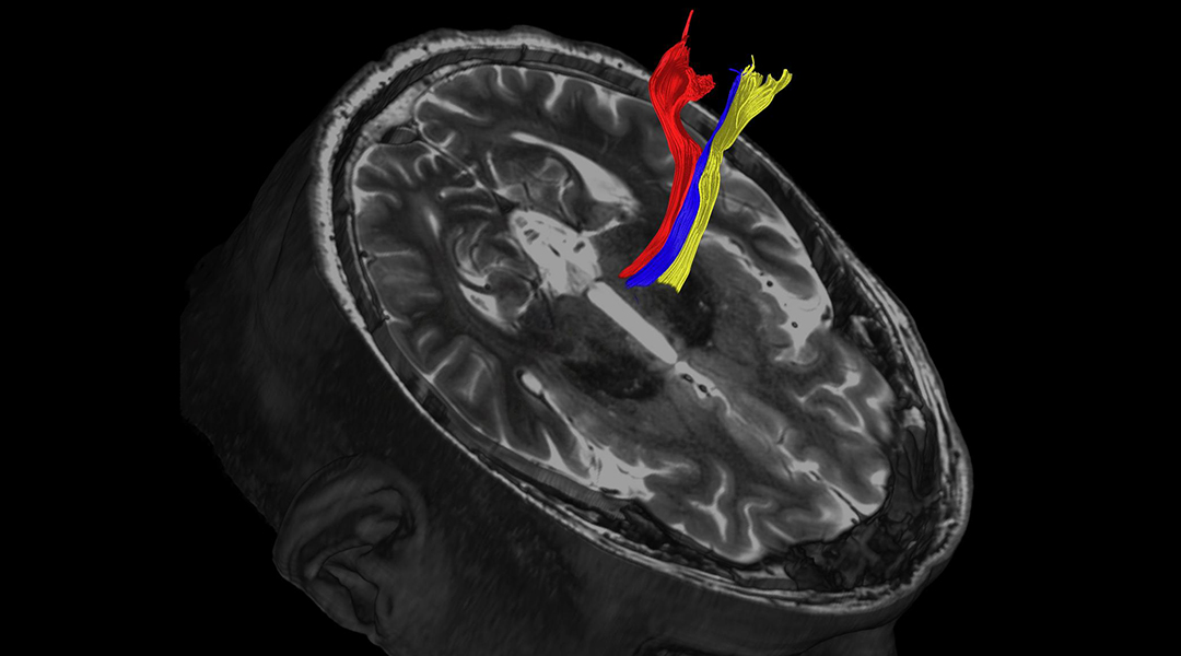 Improving treatment of Parkinson’s with better brain maps