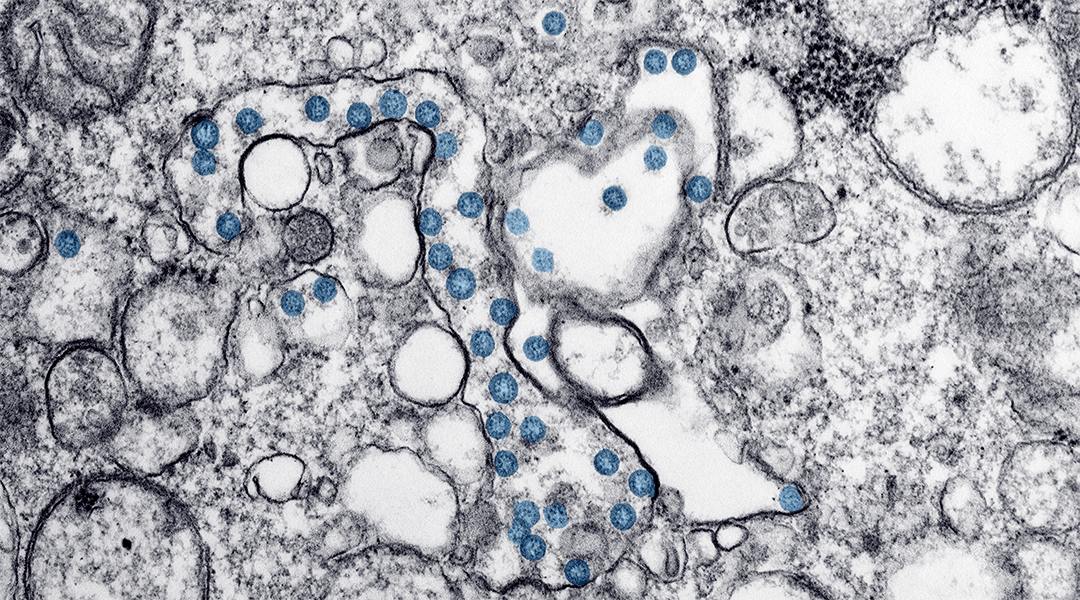 Mounting evidence for neurological symptoms of COVID-19