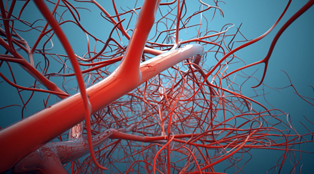 What causes deep vein thrombosis?