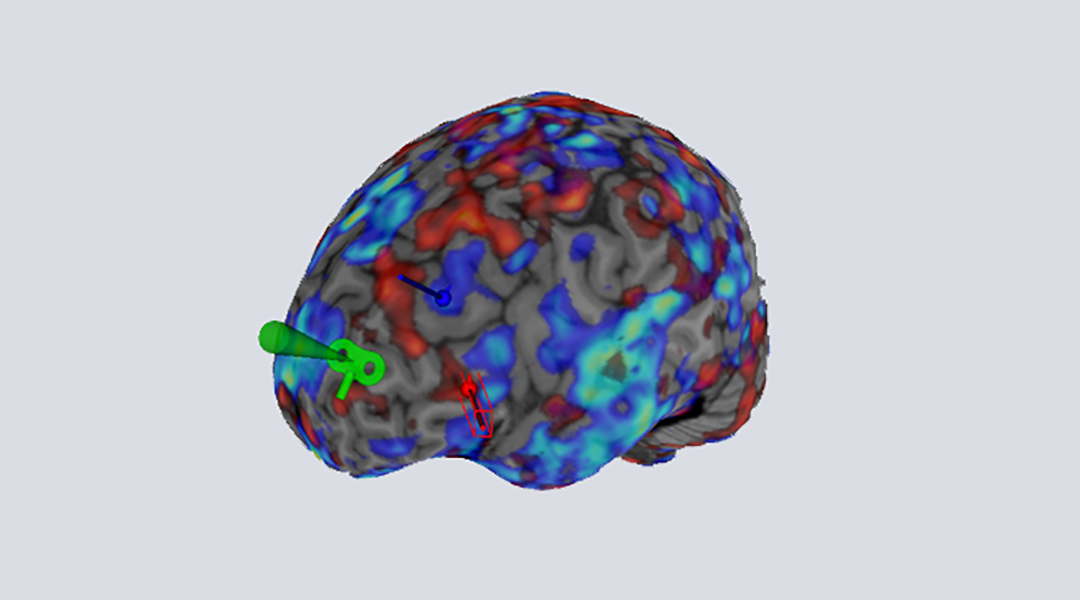 Using brain scans to personalize the treatment of depression