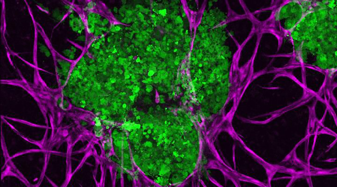 3D-bioprinted breast cancer to understand tumor growth and spread