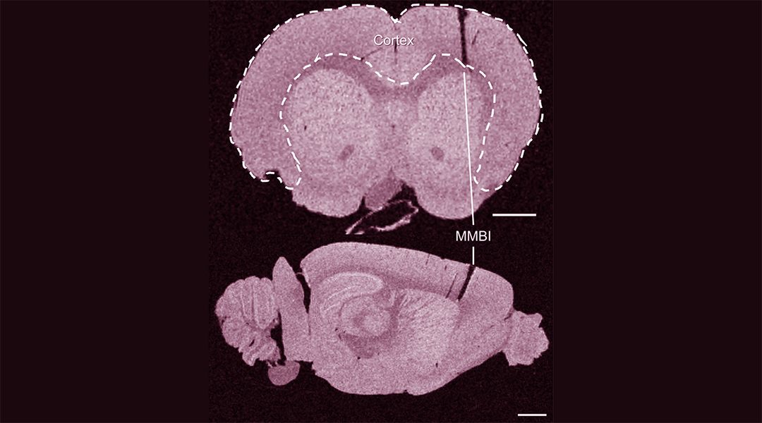 Brain implants with a short and sweet solution