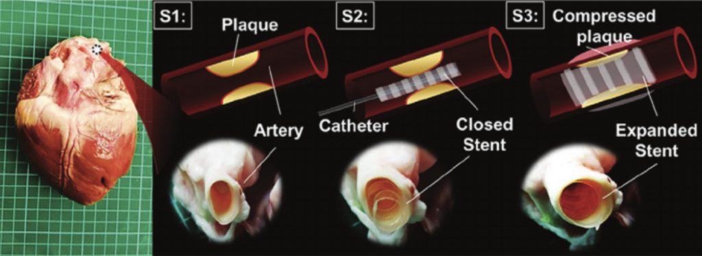A 3-photo series of a coronary artery, as described in the caption.