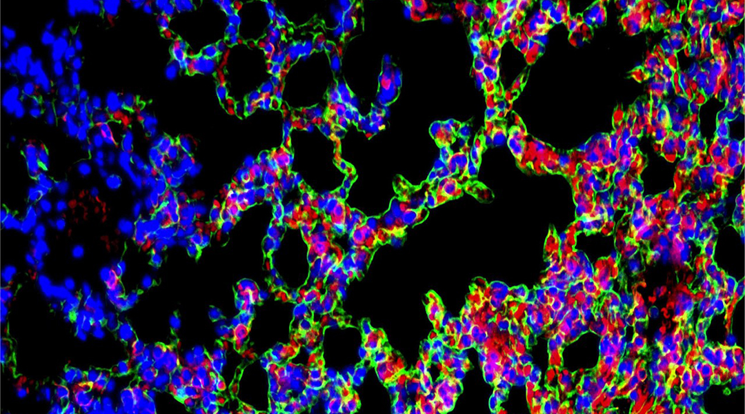 Stained lung tissue showing idiopathic pulmonary fibrosis