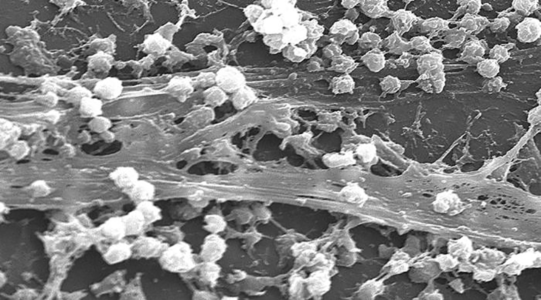 SEM image of a bacterial biofilm on a catheter.