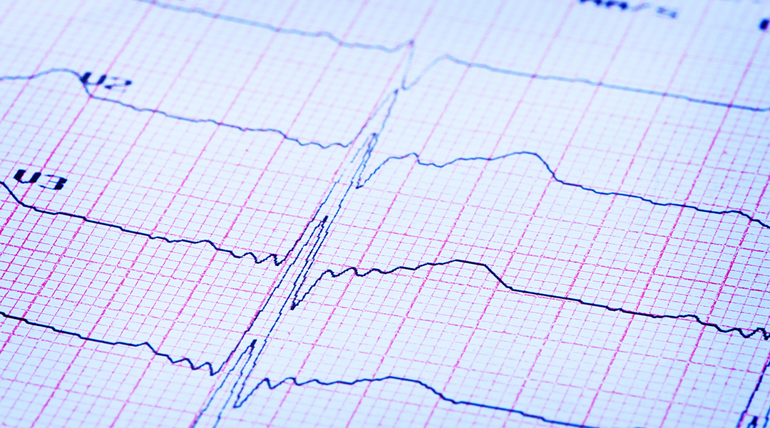 Electrocardiogram on paper.