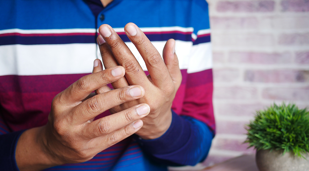 A man's hands suffering from rheumatoid arthritis