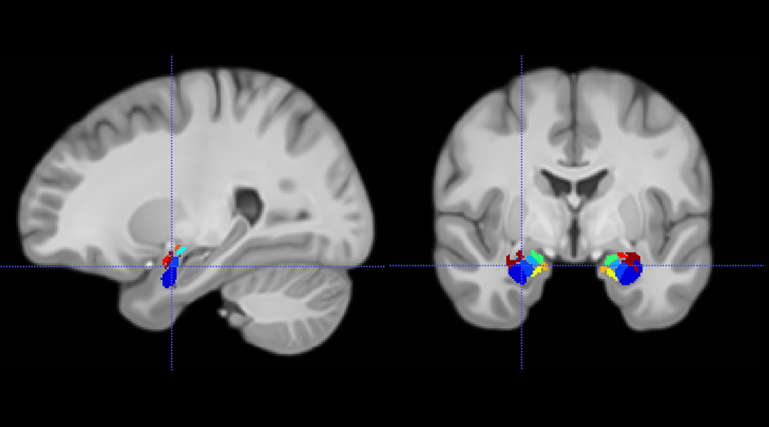 Brain MRI image