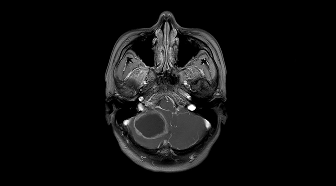 Using bacterial infections to help treat brain tumors