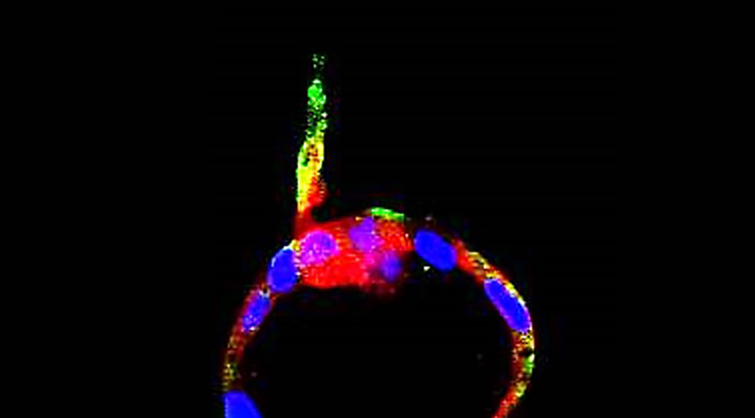 Experimental image of endometrial cancer cells.