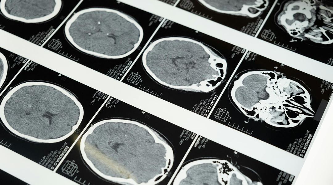 brain_cottonbro-via-pexels_5723883-crop Slides showing brain scans.